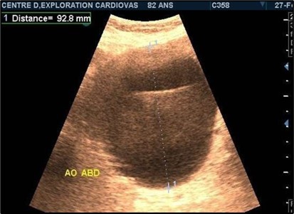 Large fusiform subrenal abdominal aortic aneurysm of 9.28cm thrombosed at 4/5 in an 82-year-old woman (CEC ‘Saint-Esprit’ from AMP-MCV).