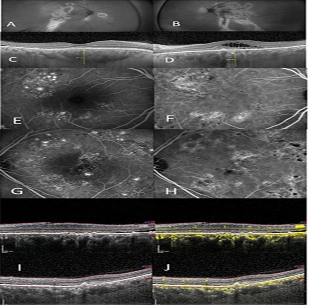 (A) right eye show autofluorescent discontinuity with peripheral tracks. (B) left eye show similar changes however central changes are present. (C), (D) OCT/EDI shows pachychoroid, pachy vessels, varying degrees of subretinal and intraretinal fluid, right eye (C), left eye (D). (E) IVFA right eye shows non-specific extrafoveal occult leakage. (F) ICG right eye with ICG hyperfluorescence and corresponding leakage. (G) IVFA leakage, left eye with several focal leaks amongst wider areas of non-focal leakage. (H) ICG shows diffuse hyperfluorescence corresponding to IVFA leakage. (I) OCT shows two images of the left macula with the “double layer sign” superior and a visible Type 2 neovascular membrane inferior, thickened choroid, and subretinal fluid and (J) with corresponding OCTA scans showing neovascularization.