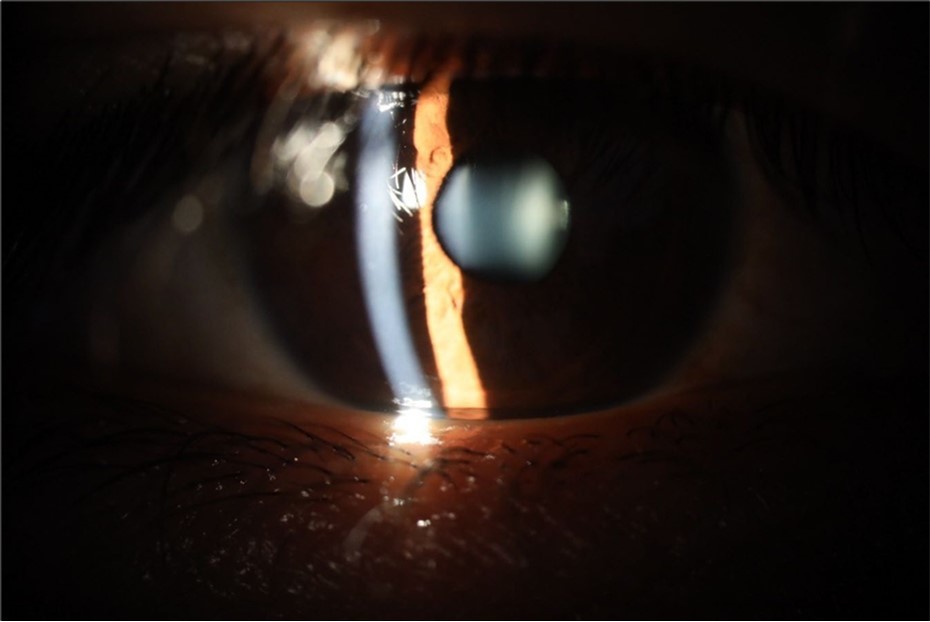 The anterior segment of the right eye responds with difficulty to mydriatics, which is usual in diseased eyes.