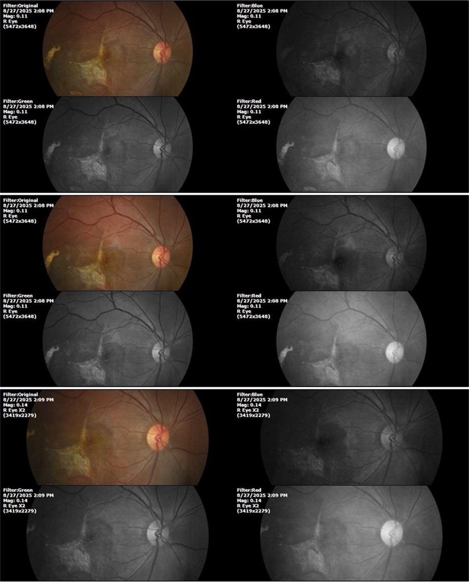 The 3 previous photographs show that whitish mass has almost completely disappeared, and to date only a remnant remains on the left side of the photograph. The chorioretinal scar that is now observed corresponds to the area affected by the blunt trauma, which presumably caused rupture of Bruch's membrane. Fortunately, the macular region has recovered almost in its entirety, so the impairment in central vision was minimal.