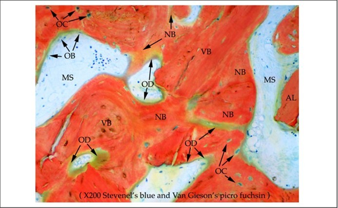 Figure 5. High power histology view. Extensive formation of immature new bone with mature vital bone. Note the numerous osteocytes in their lacunae and osteoblasts all involved in osteogenesis. NB: immature new bone. OD: Osteoid. Original magnification x 200. Stevenel’s blue and Van Gieson’s picro fuchsin.